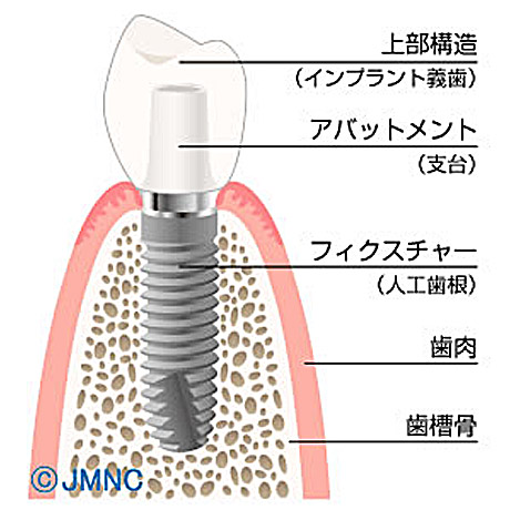 春日市(福岡) 歯医者、とくだ歯科医院のインプラント